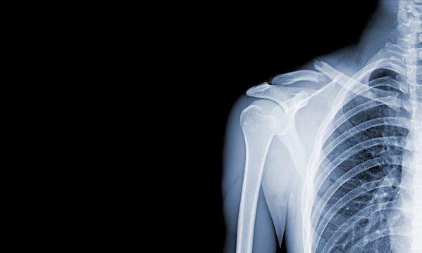 x-ray images of the shoulder joint to see injuries clavicle fracture and tendons for a medical diagnosis.Medical image concept and copy space.