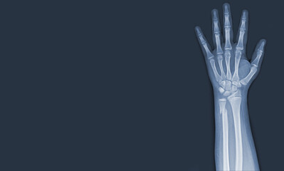 x-ray images of the hand and wrist joint to see injuries tendons and ulna bone fracture for a medical diagnosis.Medical image concept and copy space.