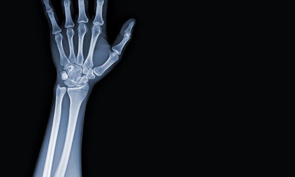 x-ray images of the hand and wrist joint to see injuries tendons soft tissue swelling for a medical diagnosis.Medical image concept and copy space.