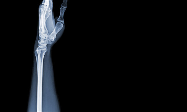 x-ray images of the hand and wrist joint lateral views to see injuries tendons soft tissue swelling for a medical diagnosis.Medical image concept and copy space.