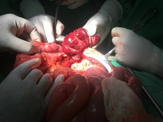 Necrotized bowel loops following small bowel intussusception at exploratory laparotomy surgery