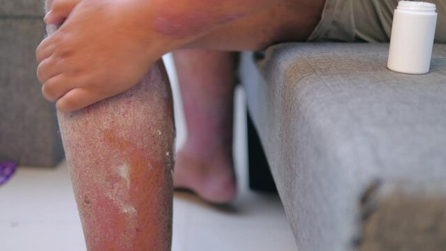 The man applying psoriasis relief cream, Medical and health care concept, The man with skin rash