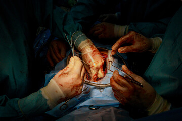 Coronary artery bypass graft CABG procedure is performed for heart operations due to coronary heart disease in operating room of hospital