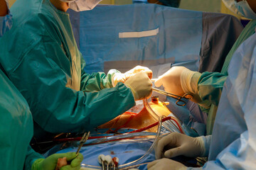 An open heart surgery is performed in operating room the case of a malfunctioning heart valve,...