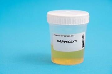 Carvedilol. Carvedilol toxicology screen urine tests for doping and drugs