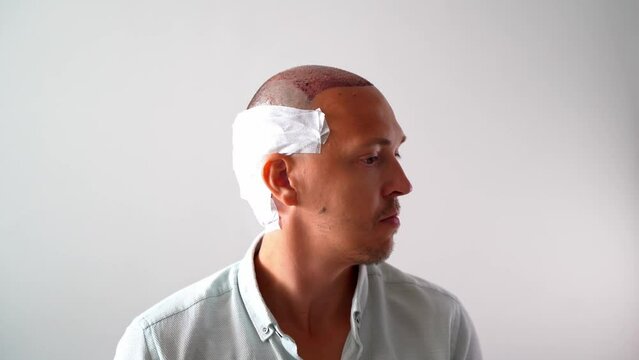 After hair transplantation surgical technique that moves hair follicles. Young bald man in bandage with hair loss problems. White background with copy space.