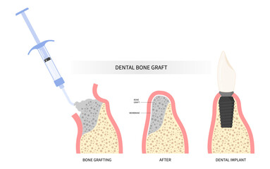 Procedure of Teeth bone Graft surgery - obrazy, fototapety, plakaty