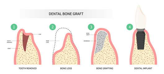 Dental surgery for oral teeth implant with bone graft procedure - obrazy, fototapety, plakaty
