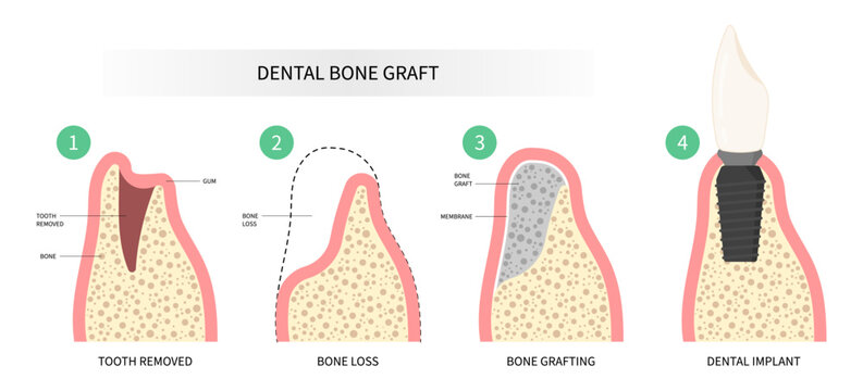Dental surgery for oral teeth implant with bone graft procedure