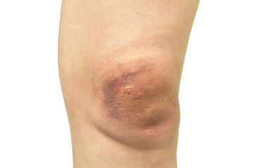 Domestic violence wound on leg isolated on white background with clipping path