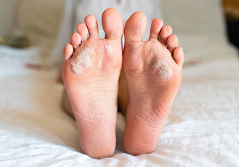 Problems with the skin of the feet. Dermatological diseases. Close-up. - obrazy, fototapety, plakaty