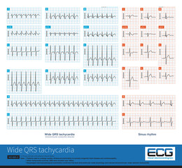 If there is basic intraventricular conduction disorder in sinus rhythm, wide QRS wave tachycardia can be seen in supraventricular tachycardia, which is easily misdiagnosed as ventricular tachycardia.