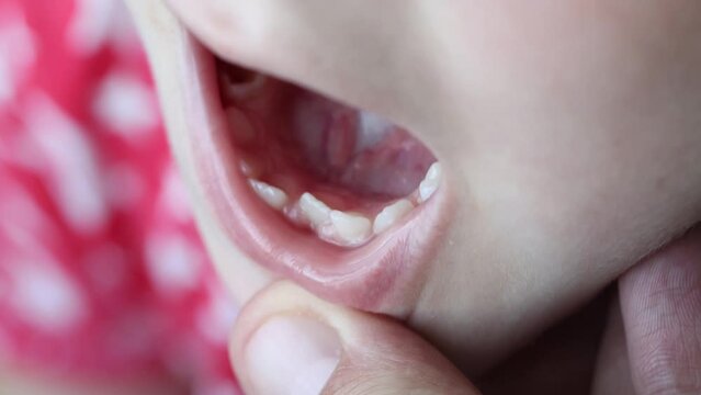 The change of milk teeth in a child to permanent, crooked, uneven teeth in the jaw in children. Close-up