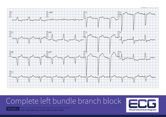 In complete left bundle branch block, the QRS wave in lead V1 is usually in rS and QS morphologies, with QRS duration ≥ 120ms, which is common in organic heart disease.