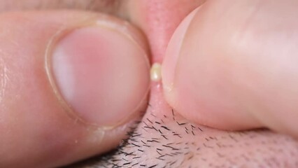 Macro video, squeezing a white pimple from the face. 