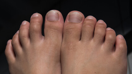 brittle toenails in children cause the surface layer of the nail or lamella to peel off with some...
