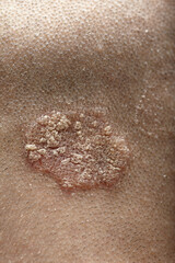 Eczema caucasian male head back