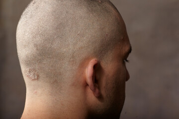 Eczema caucasian male head back