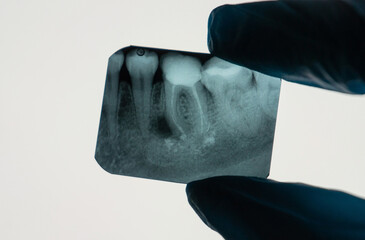 Dental Periapical Granuloma next to tooth root on an X-ray held by a Dentist