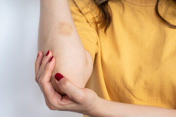 Cropped shot of woman showing bruise occur on her skin. A bruise is a common skin injury that...
