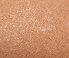 pigment spots on the skin after a sunburn