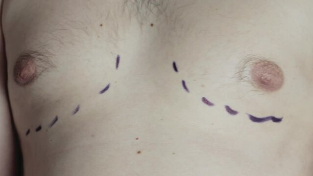 Male breast with black marker marks for a male breast reduction surgery, close-up.