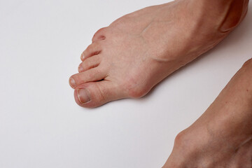 Hallux valgus deformity of the foot on the girl's leg requires treatment