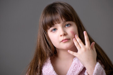 Food allergy in a young child on the cheeks ,  little girl has eczema on her face.