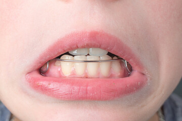 Obraz premium The boy wears a dental plate on his lower jaw.