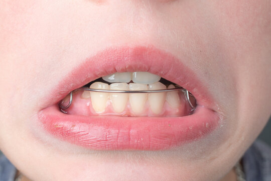 The boy wears a dental plate on his lower jaw.
