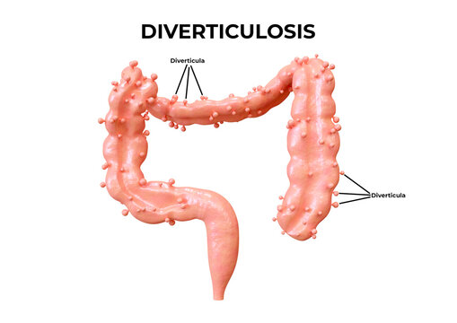 diverticulosis is a gastrointestinal disorder in which diverticula form in the intestine
