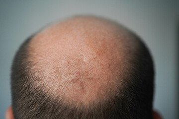 Bald head close-up. The problem of hair loss in men. Alopecia in men.