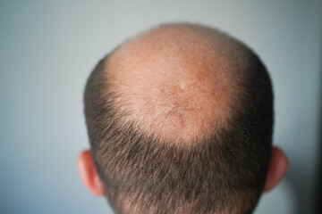 Bald head close-up. The problem of hair loss in men. Alopecia in men. - obrazy, fototapety, plakaty