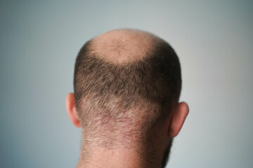 Obraz premium Bald head close-up. The problem of hair loss in men. Alopecia in men.