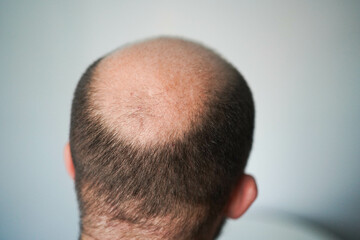 Obraz premium Bald head close-up. The problem of hair loss in men. Alopecia in men.