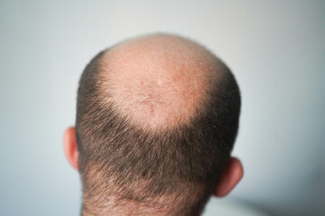 Obraz premium Bald head close-up. The problem of hair loss in men. Alopecia in men.