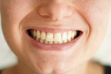 Fototapeta premium A smile with open teeth. Straight teeth. Result after orthodontic treatment.
