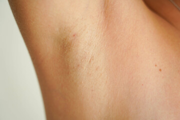 Women's armpit close-up. Thin and sparse hair on a female armpit. The result after completing an incomplete course of laser hair removal. - obrazy, fototapety, plakaty
