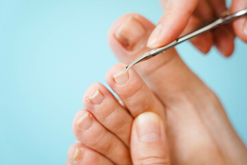Close-up of problematic nails. Nail disease. The process of performing a pedicure with nail clippers.