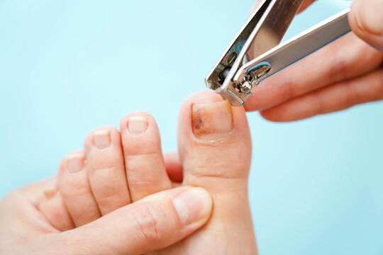 Close-up of problematic nails. Nail disease. The process of performing a pedicure with nail clippers.