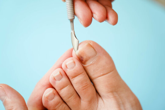 Close-up of problematic nails. Nail disease. The process of performing a pedicure with nail clippers.