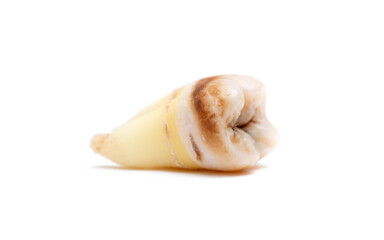 Close-up of a tooth with caries isolated on a white background. Removed wisdom teeth. Sick human teeth.