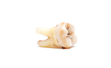 Close-up of a tooth with caries isolated on a white background. Removed wisdom teeth. Sick human teeth.