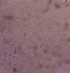 Microscopic fungi Malassezia furfur, showing yeast cells and hyphae. They are associated with dandruff, seborrhoeic dermatitis and tinea versicolor. Skin scraping for fungus.