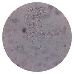 Microscopic fungi Malassezia furfur, showing yeast cells and hyphae. They are associated with...
