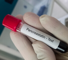 Blood sample for Pancreastatin test to diagnosis the incidence of liver metastasis with small-bowel...