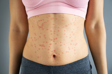 Body Skin With Psoriasis Autoimmune Disease
