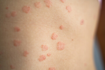 Fototapeta premium Body Skin With Psoriasis Autoimmune Disease