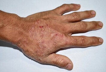 Itchy skin lesions in hand of Asian man. It may be caused by scabies infestation or fungal...