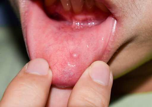 Small vesicle lesion at lower lip